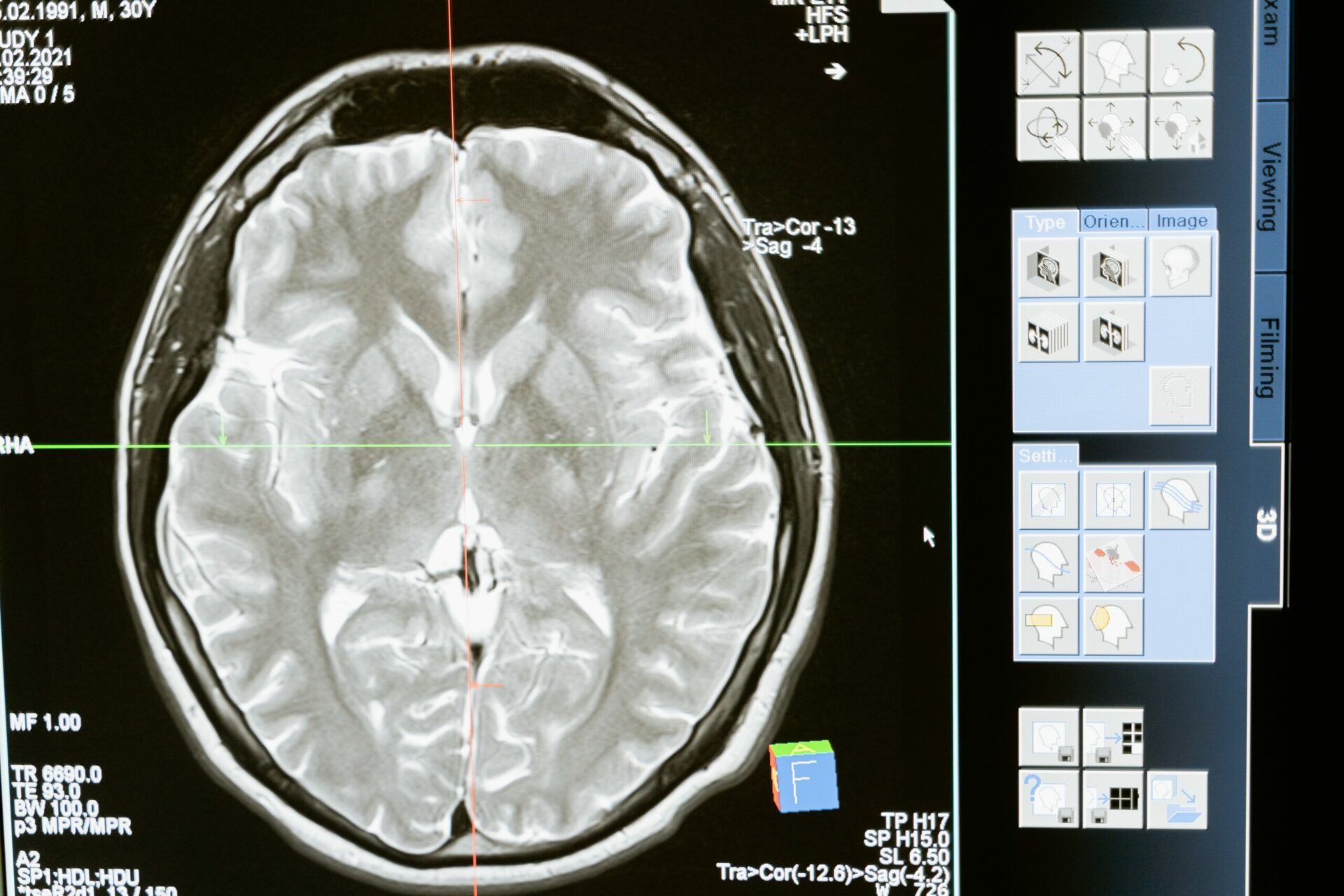 Ictus O Infarto Cerebral Qué Es Cómo Detectarlo Y Cuáles Son Los Síntomas